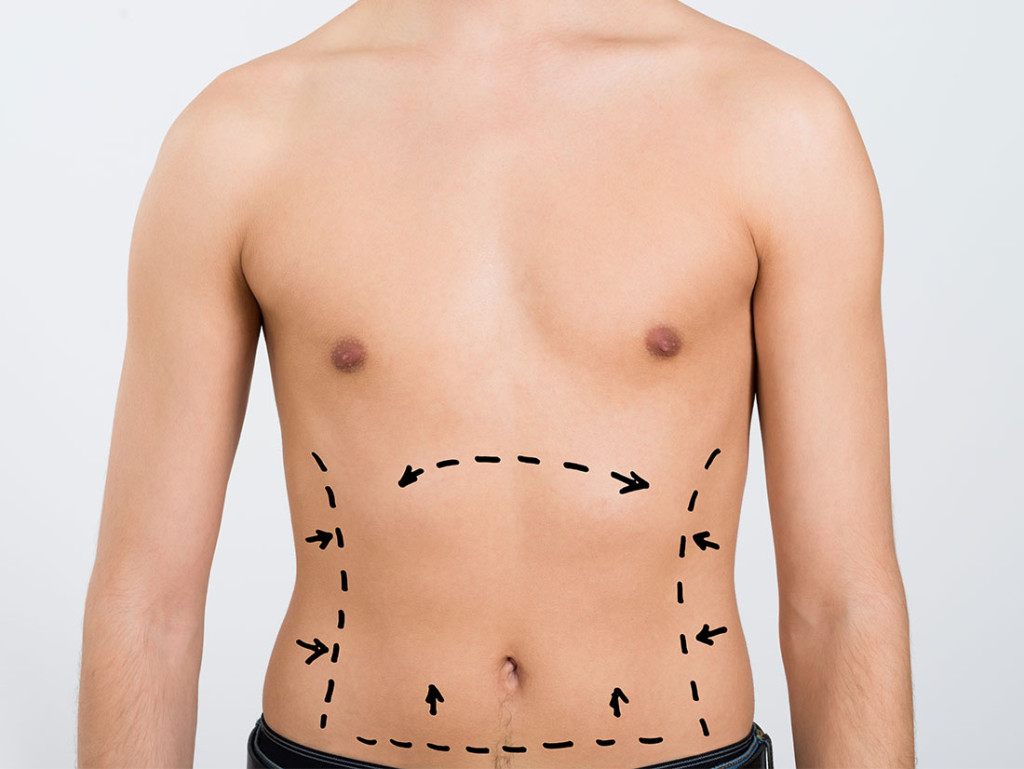 Liposuction (Vacuum Fat Extraction Surgery)