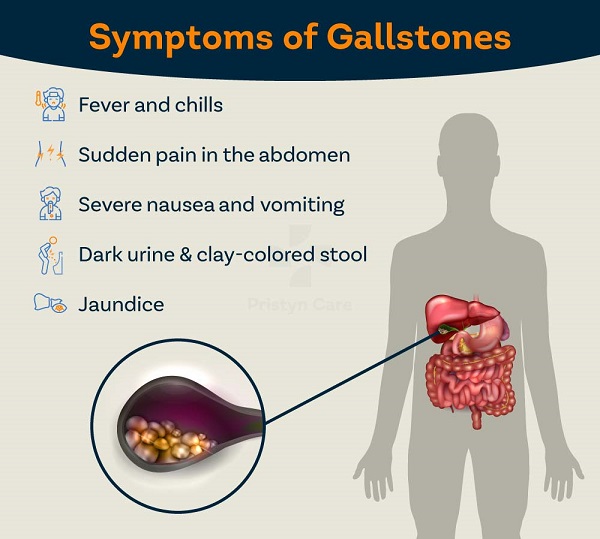 treatment-options-for-gallstnes-include