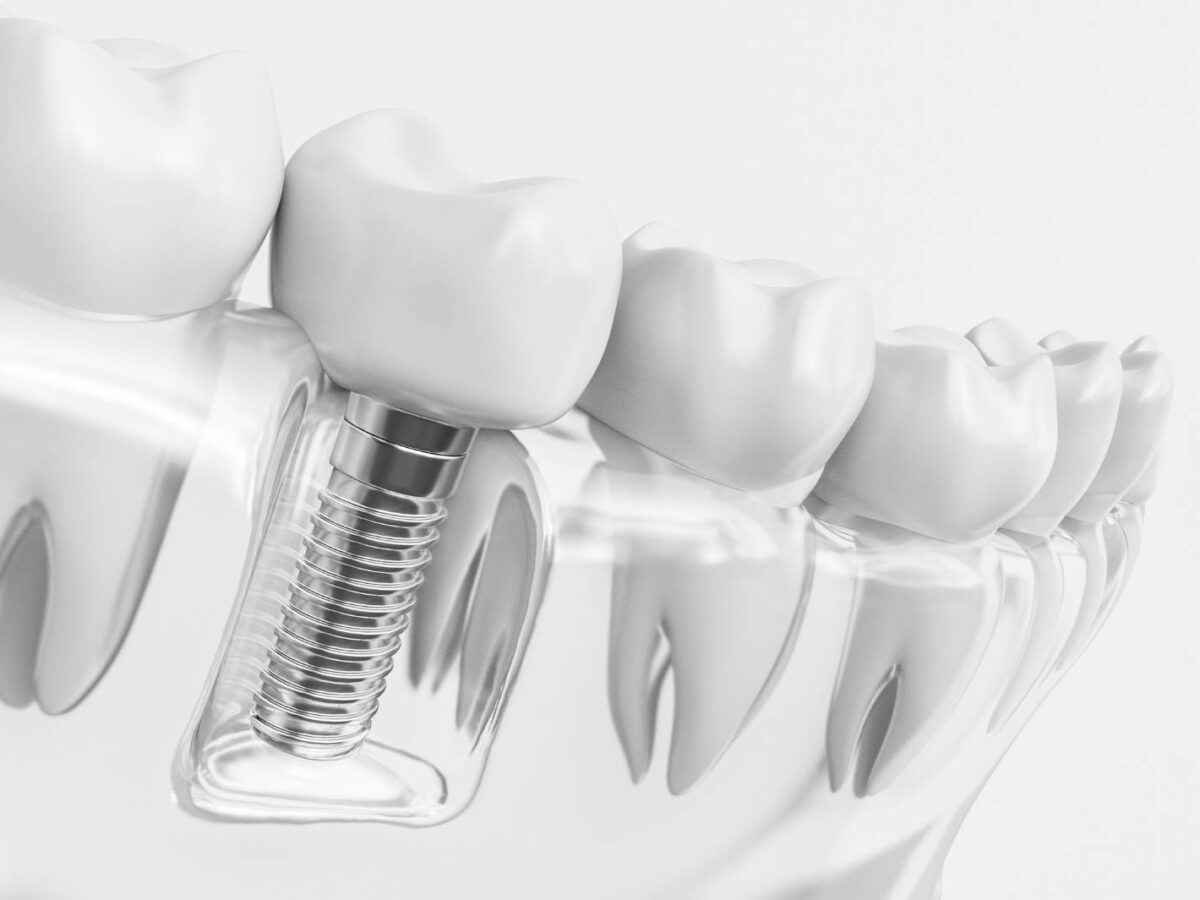 Things to Consider After Making a Temporary Prosthesis Over the Implant
