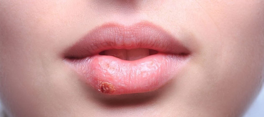 What is herpes?