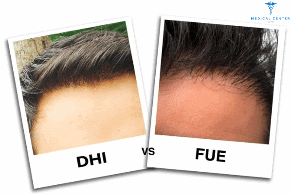 differences-between-fue-and-dhi-hair-transplant